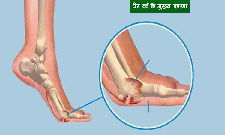 पैर दर्द के मुख्य कारण